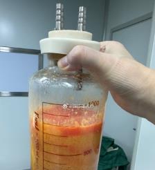 长春水动力吸脂手术要做多久？